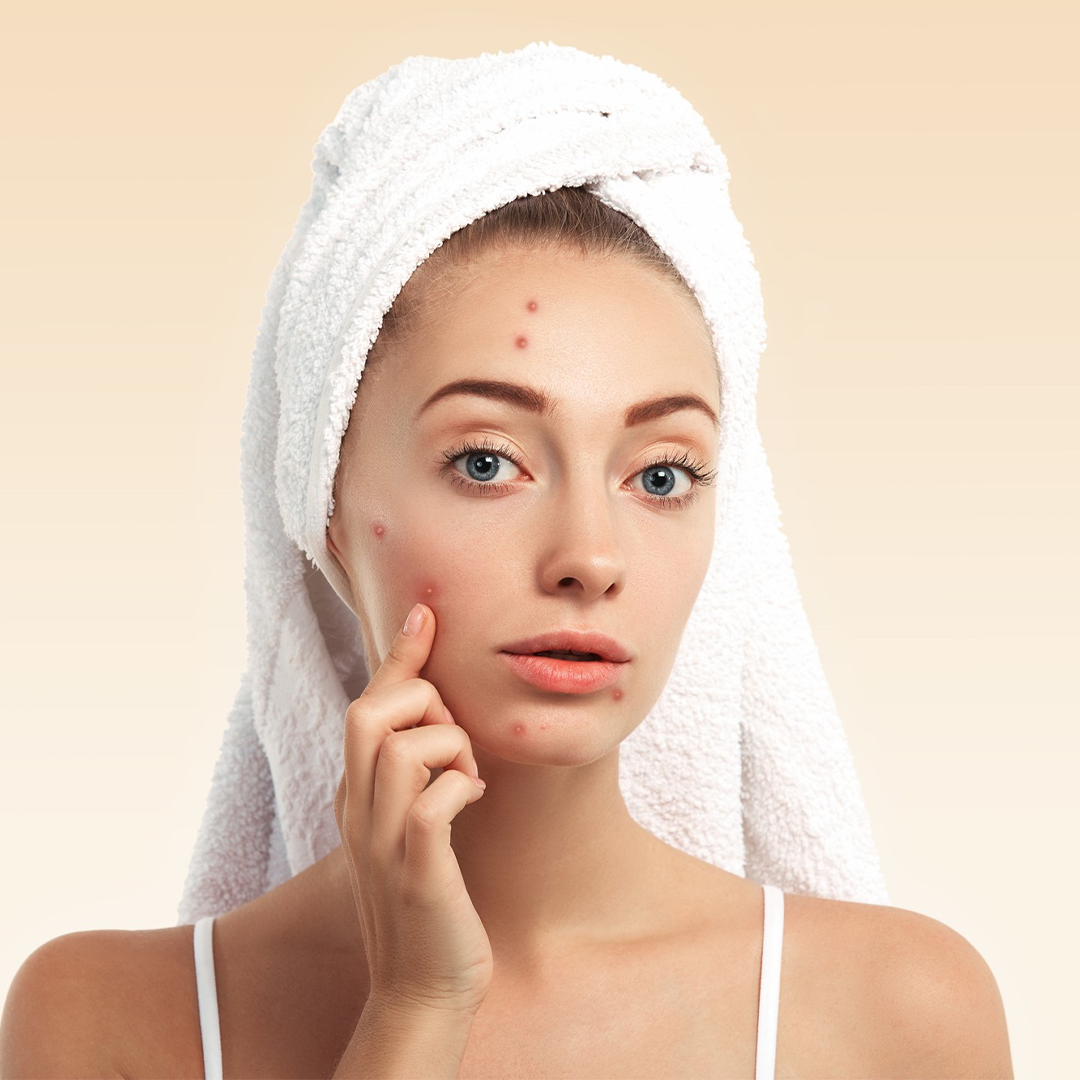 Clear, acne-free skin